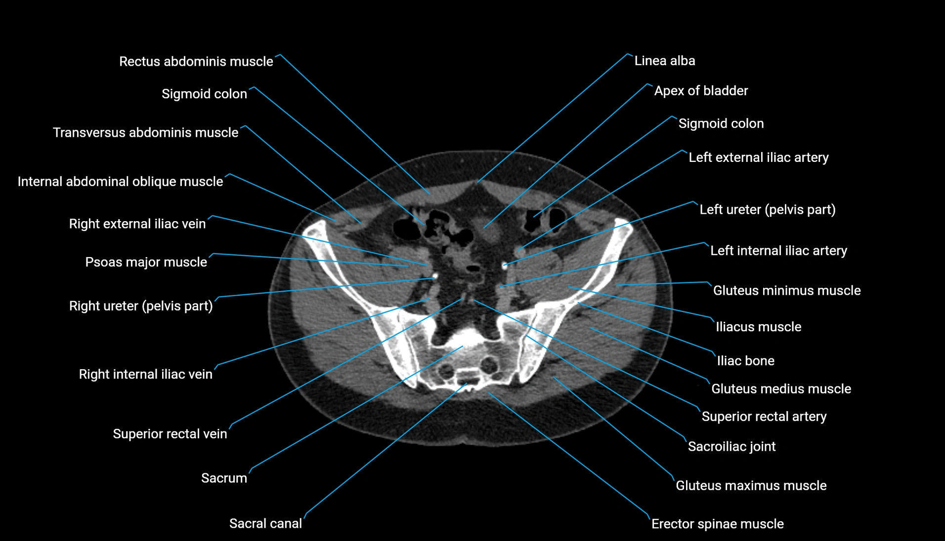 CT urogram axial cross sectional anatomy  labelled radiology image-00193.webp